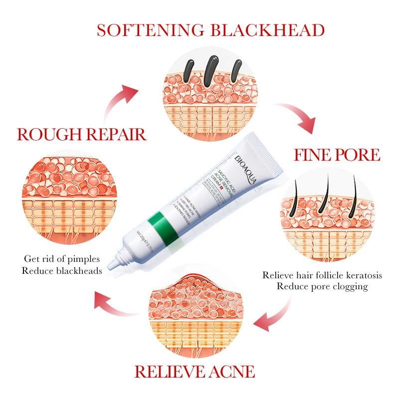 1/2PCS BIOAOUA Acid Acne Removing Cream Making The Skin Even And Smooth Dredging And Clearing Pores Removing Dead Skin