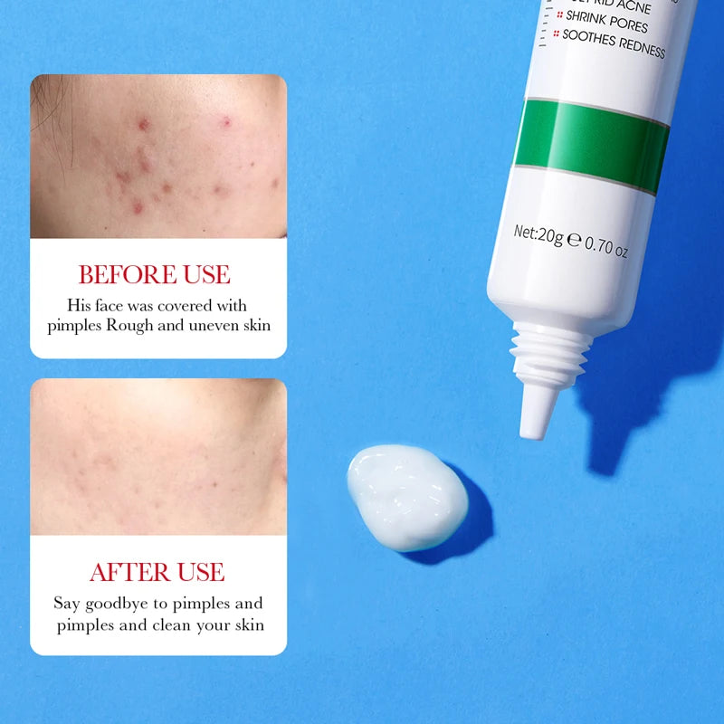 1/2PCS BIOAOUA Acid Acne Removing Cream Making The Skin Even And Smooth Dredging And Clearing Pores Removing Dead Skin